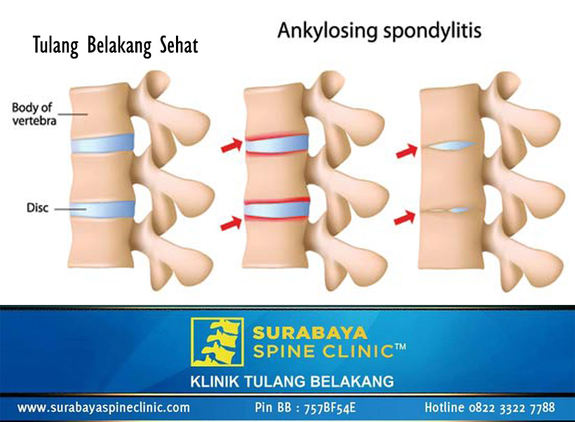 Ankylosing Spondylitis, Tulang Belakang Bambu